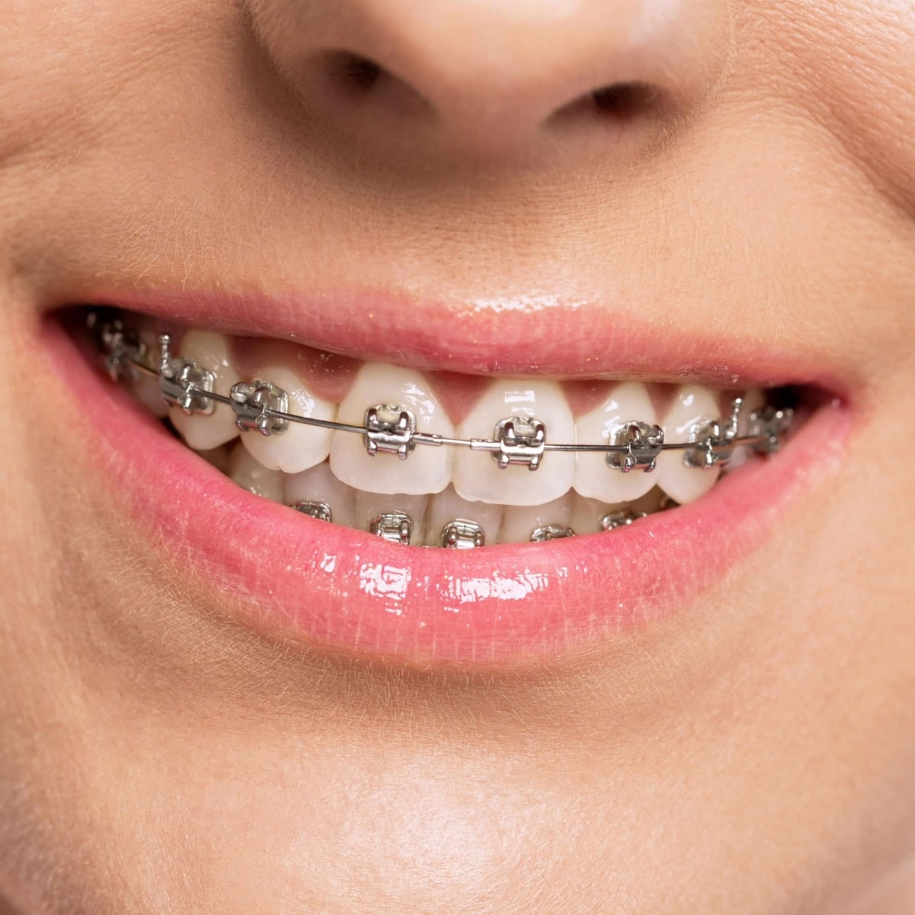 Traditional Braces  Unique Orthodontics